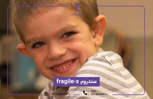 سندروم Fragile-X
