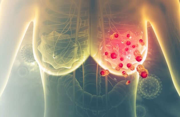 سرطان پستان (سینه) در زنان | علت، انواع، علائم، پیشگیری، تست، تشخیص، درمان