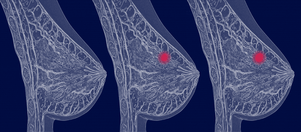 علائم و نشانه‌های سرطان پستان
