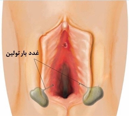 کیست غده بارتولن چگونه تشخیص داده می‌شود؟
