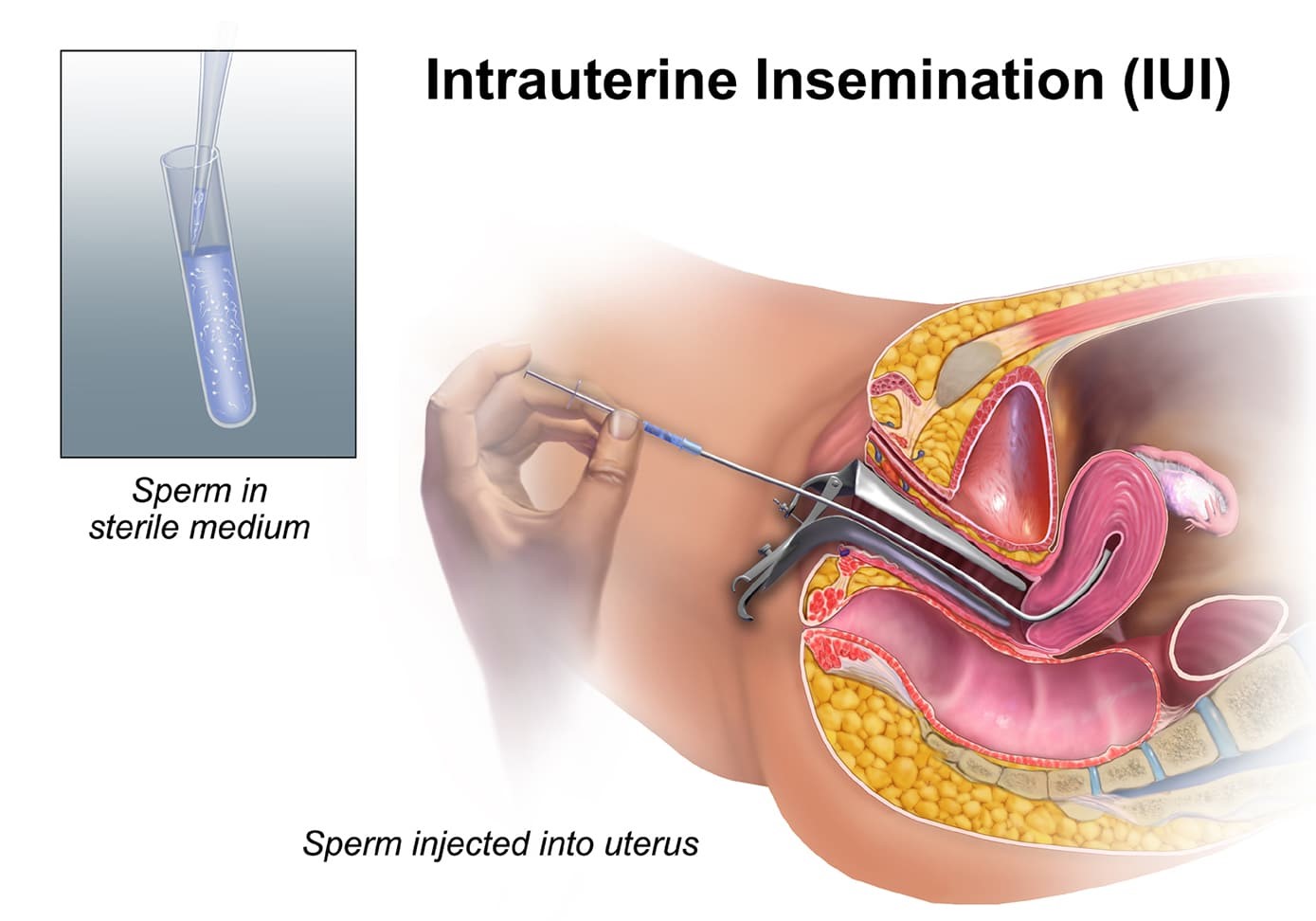 درمان ناباروری به روش IUI (تلقیح داخل رحمی اسپرم با آی یو آی)