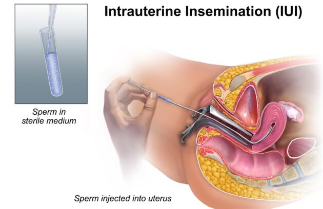 درمان ناباروری به روش IUI (تلقیح داخل رحمی اسپرم با آی یو آی)
