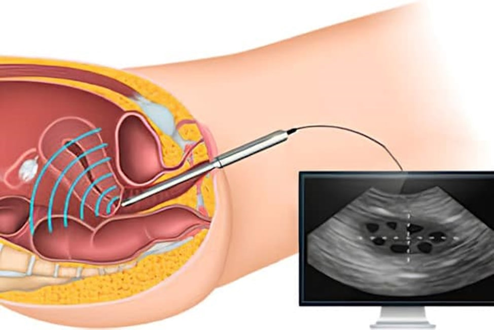 آشنایی با سونوگرافی واژینال