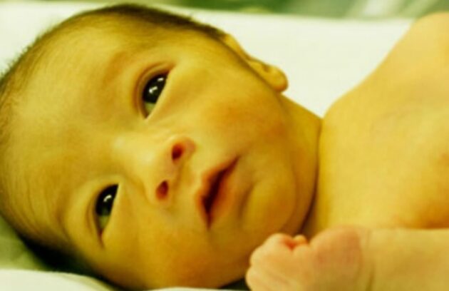 زردی نوزاد چیست؟ | علائم، تشخیص، عوارض، درمان