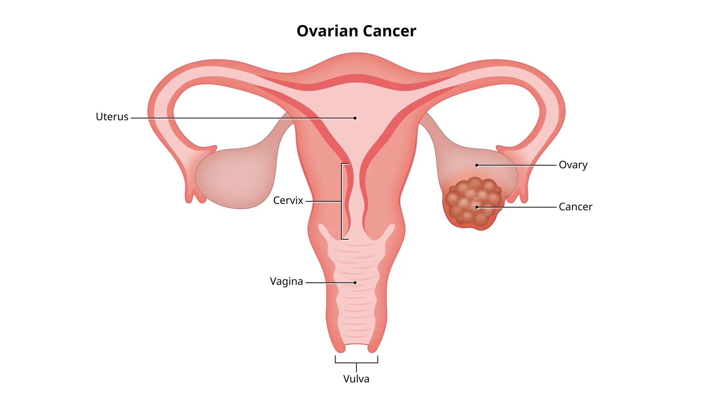 سرطان تخمدان | علت، علائم، پیشگیری، تشخیص و درمان