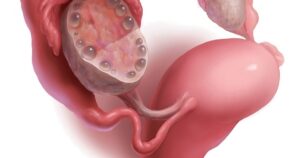 سندروم تخمدان پلی کیستیک | علائم، تشخیص و درمان