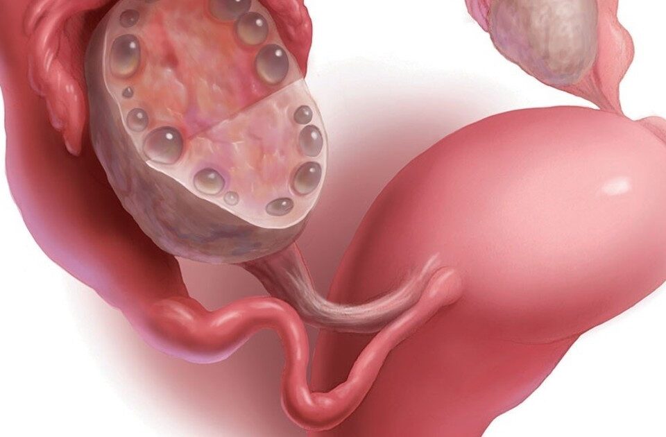 سندروم تخمدان پلی کیستیک | علائم، تشخیص و درمان