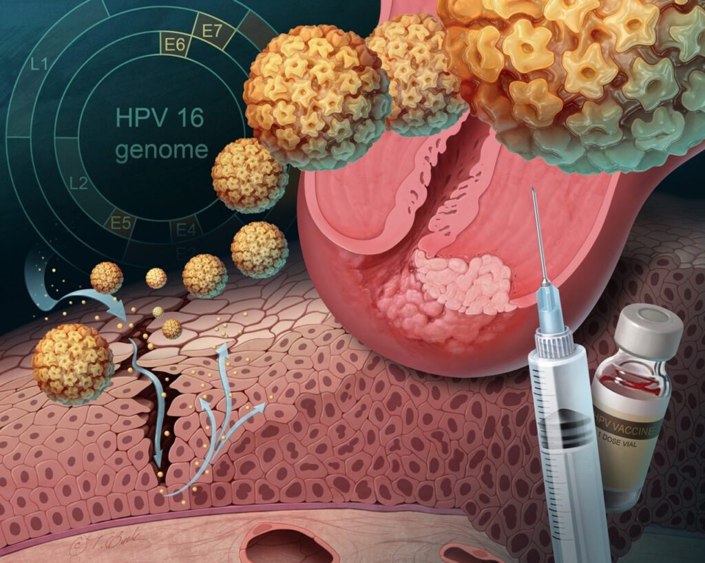 پیشگیری از ویروس HPV که باعث پیشگری از سرطان پستان نیز می شود