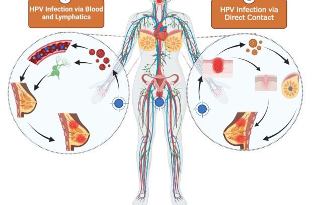 ارتباط بین ویروس HPV و سرطان سینه (پستان) در زنان