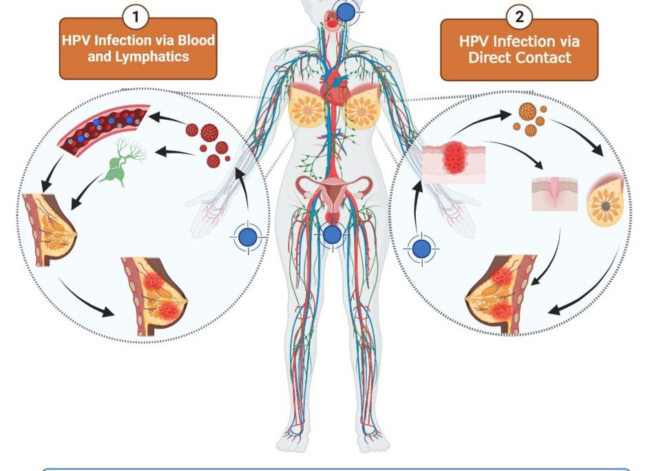 ارتباط بین ویروس HPV و سرطان سینه (پستان) در زنان