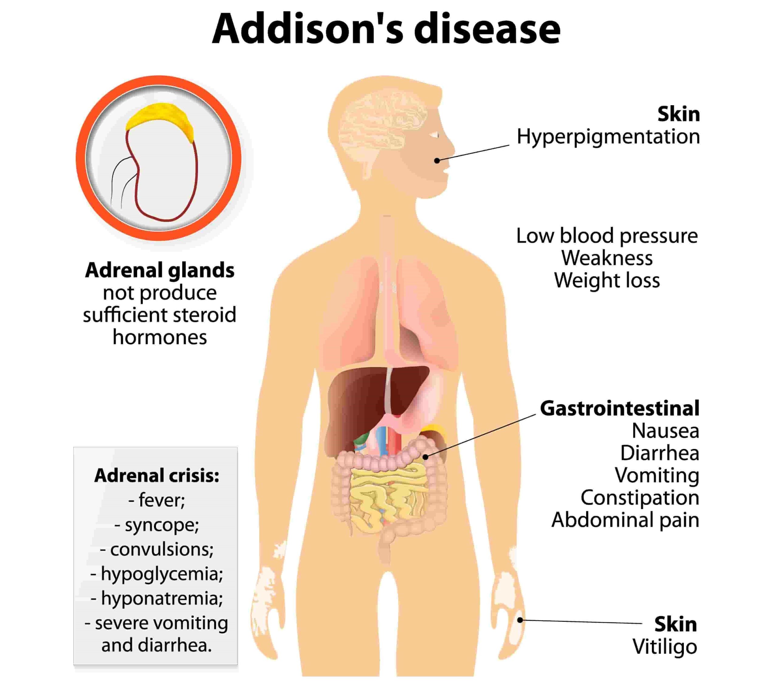 مهم‌ترین علائم بیماری آدیسون چیست؟