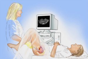 سونوگرافی واژینال | نحوه انجام، کاربرد، مزایا و عوارض
