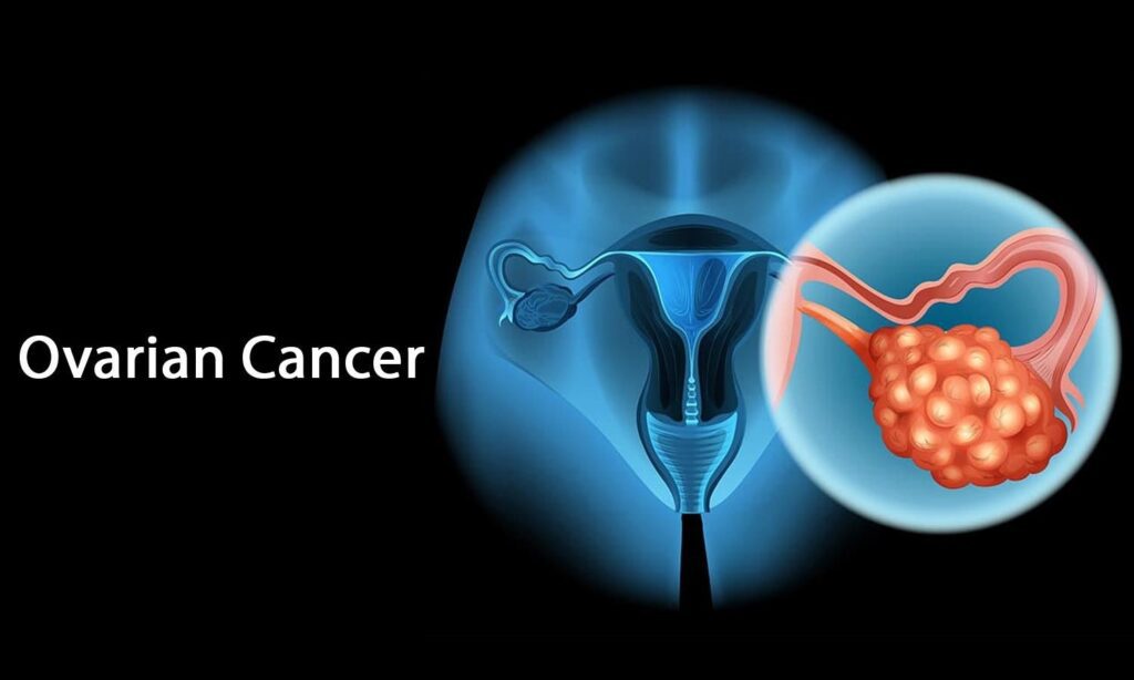 سرطان تخمدان چیست؟