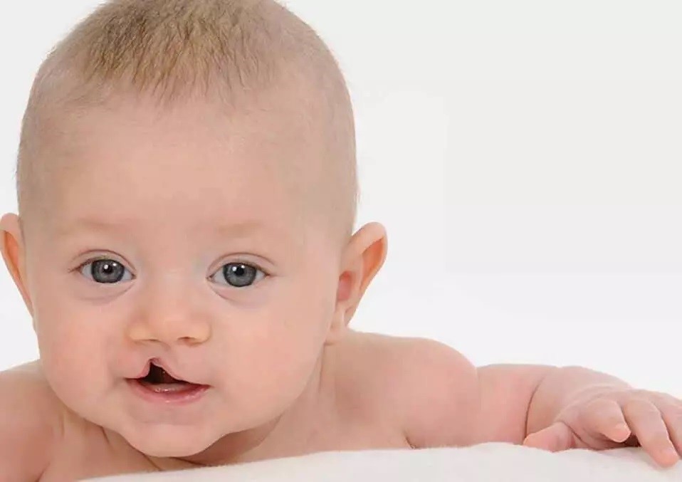 تریزومی ۱۳ (سندروم پاتو) چیست؟