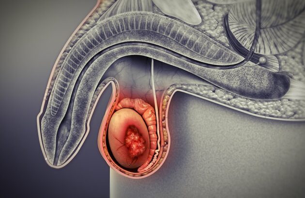 سرطان بیضه | علائم، تشخیص، پیشگیری و درمان