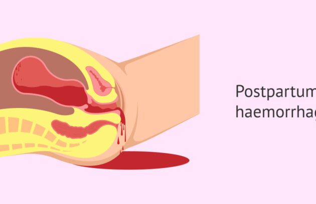 خونریزی بعد از زایمان طبیعی و سزارین