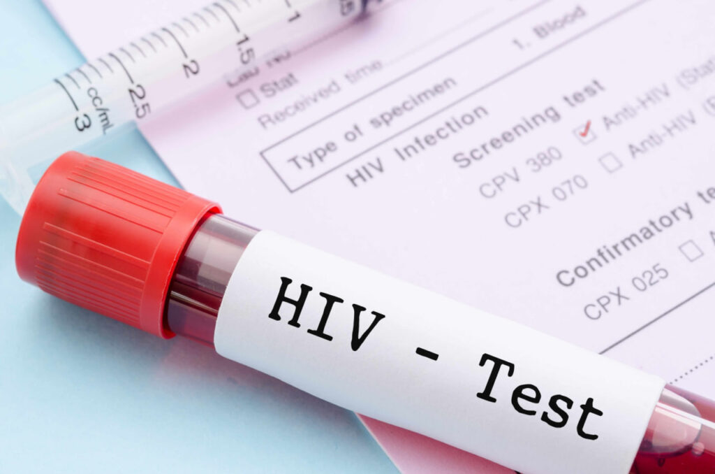 آزمایش HIV