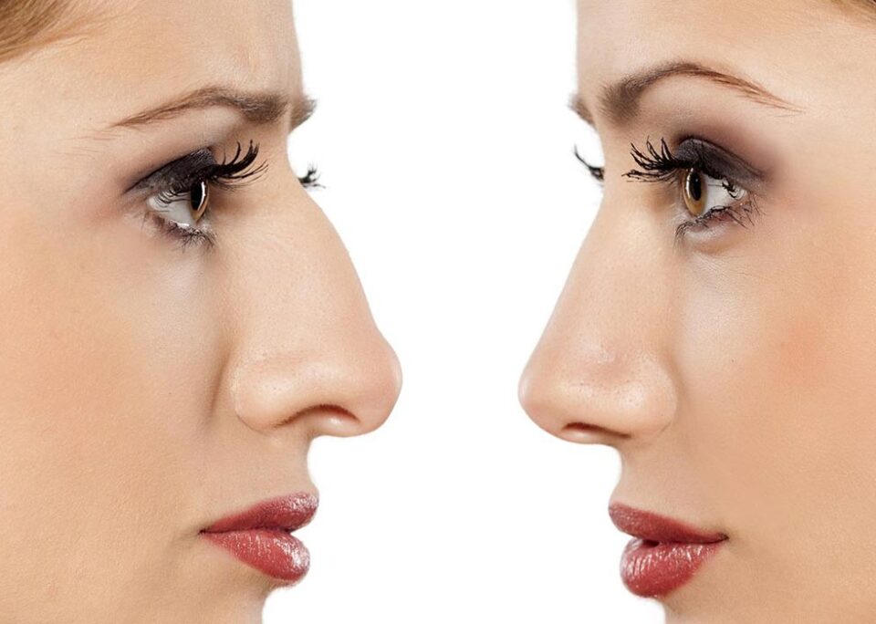 انواع آزمایش قبل از عمل بینی