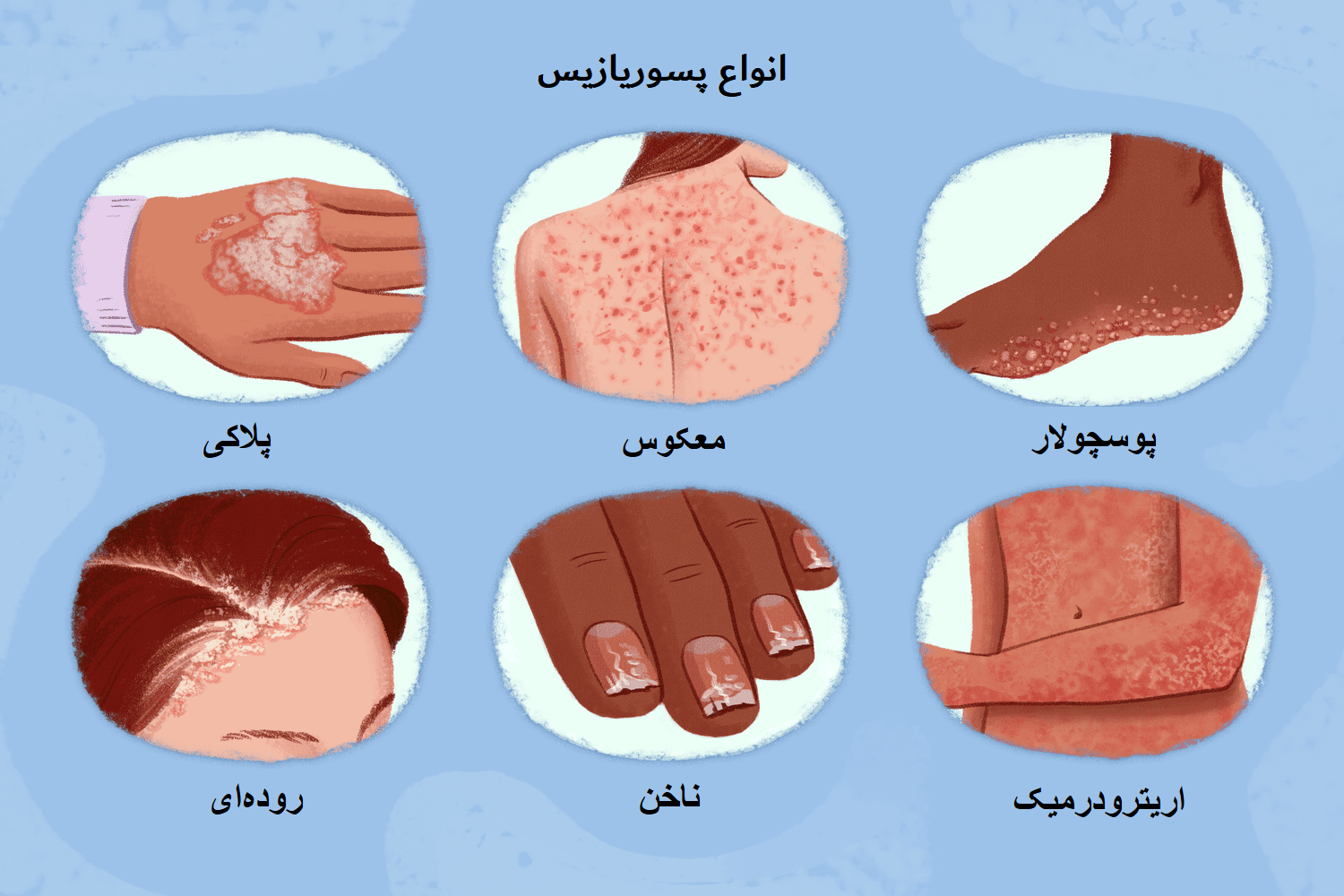 انواع پسوریازیس