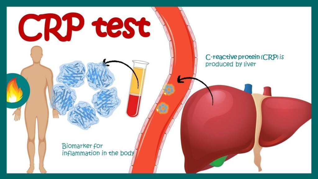 آزمایش CRP خون | تفسیر آزمایش پروتئین فعال C