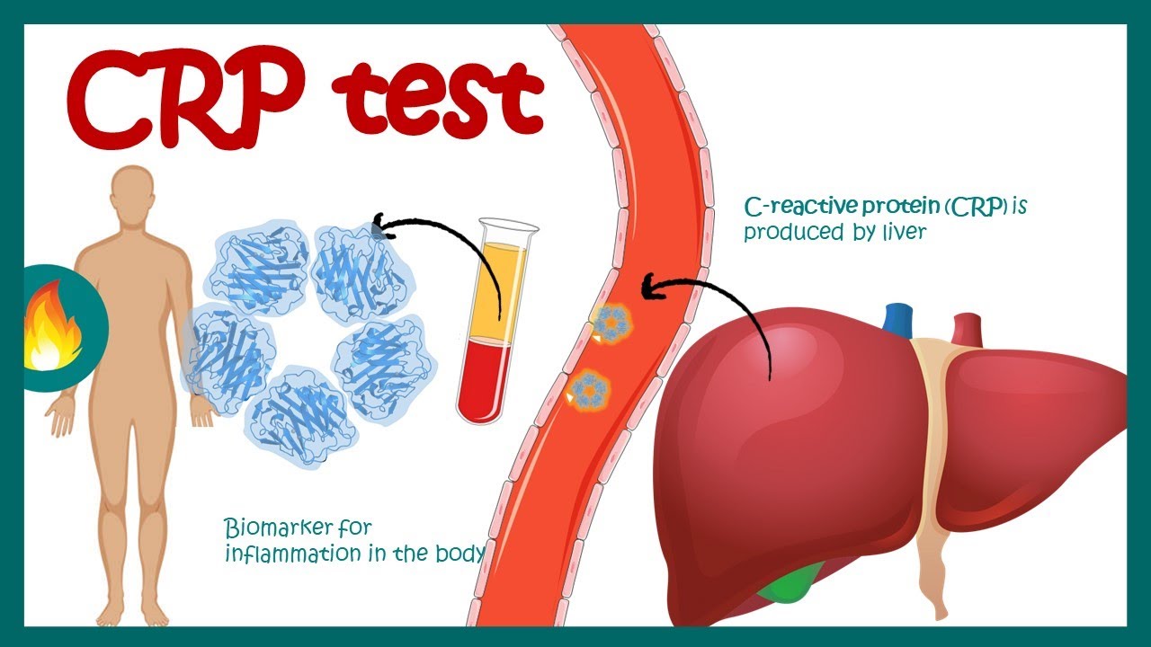 آزمایش CRP خون