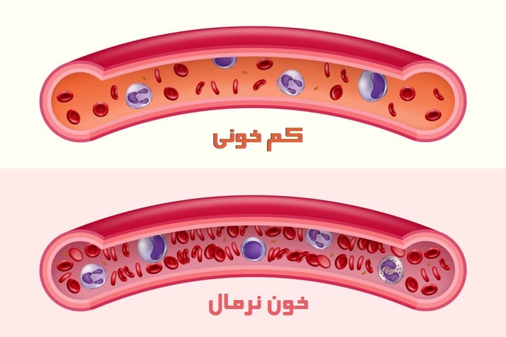 علائم کم خونی