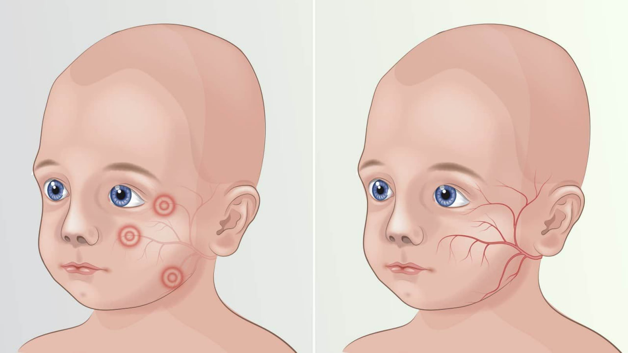 بیماری فنیل کتونوری چیست؟ | بررسی جهشهای ژن PAH