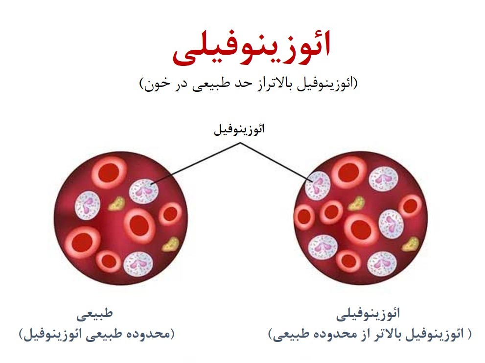 ائوزینوفیلیا (Eosinophilia)