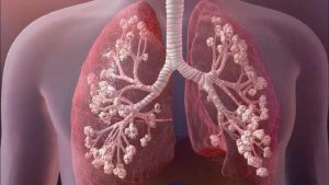 فیبروز کیستیک (CF) چیست؟ | آزمایش بررسی جهش‌های شایع ژن CFTR