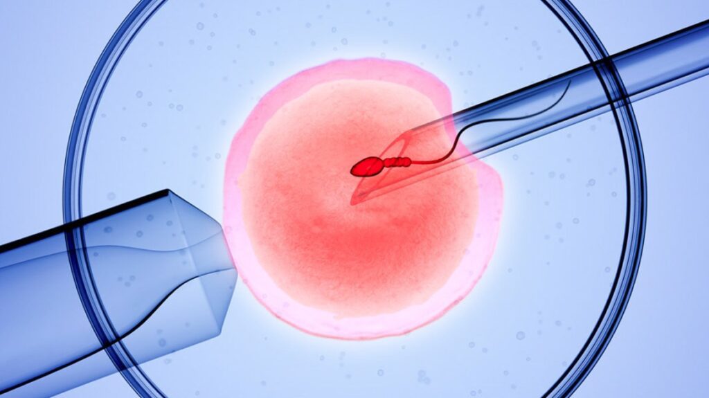 روش IVF (In Vitro Fertilization) برای دختردار شدن و پسردار شدن