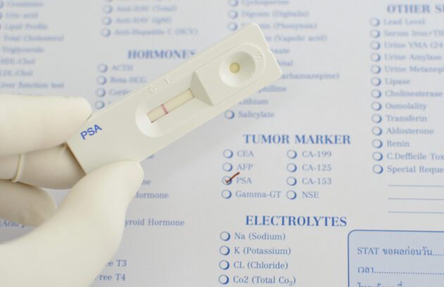 آزمایش پروستاتpsa-test