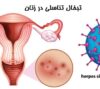 تبخال ناحیه تناسلی در زنان