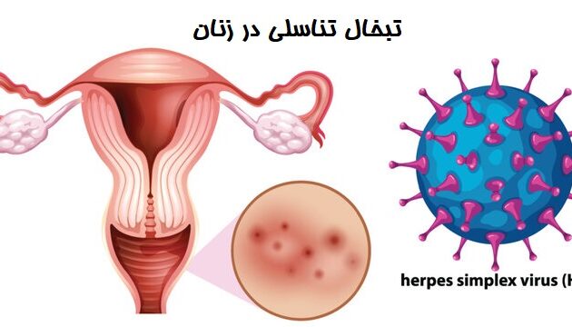 تبخال ناحیه تناسلی در زنان