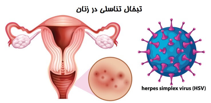 تبخال ناحیه تناسلی در زنان