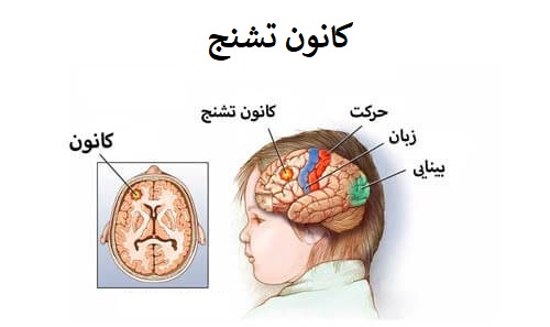 تشنج کانونی