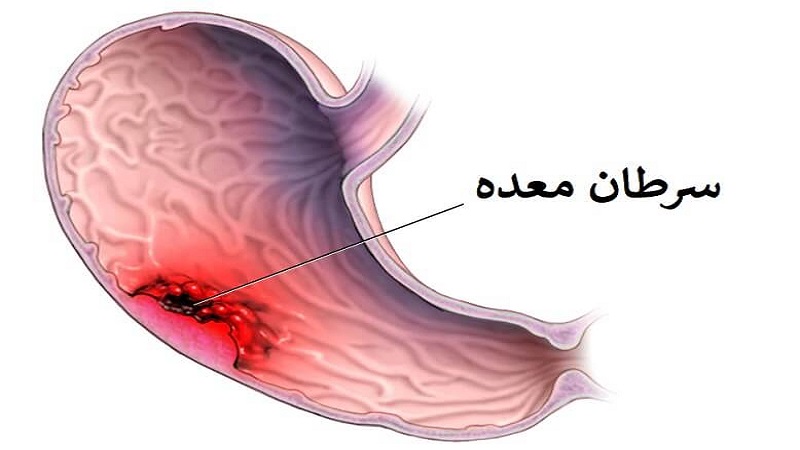 سرطان معده چیست؟