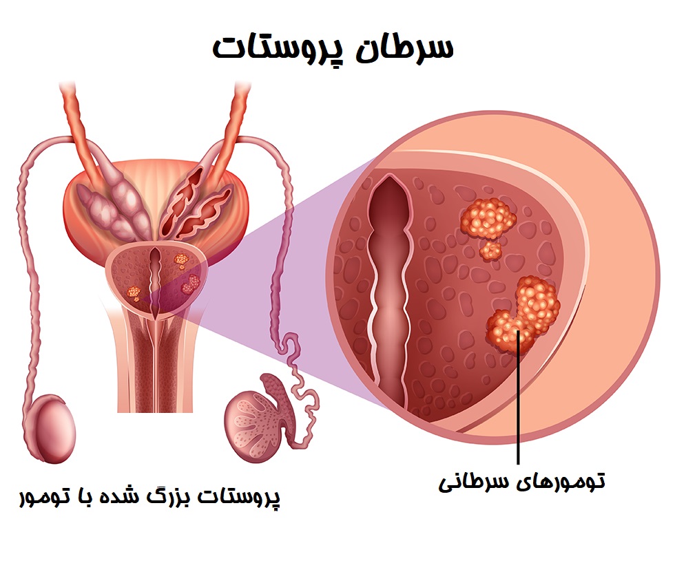 سطح بالای PSA و احتمال سرطان پروستات