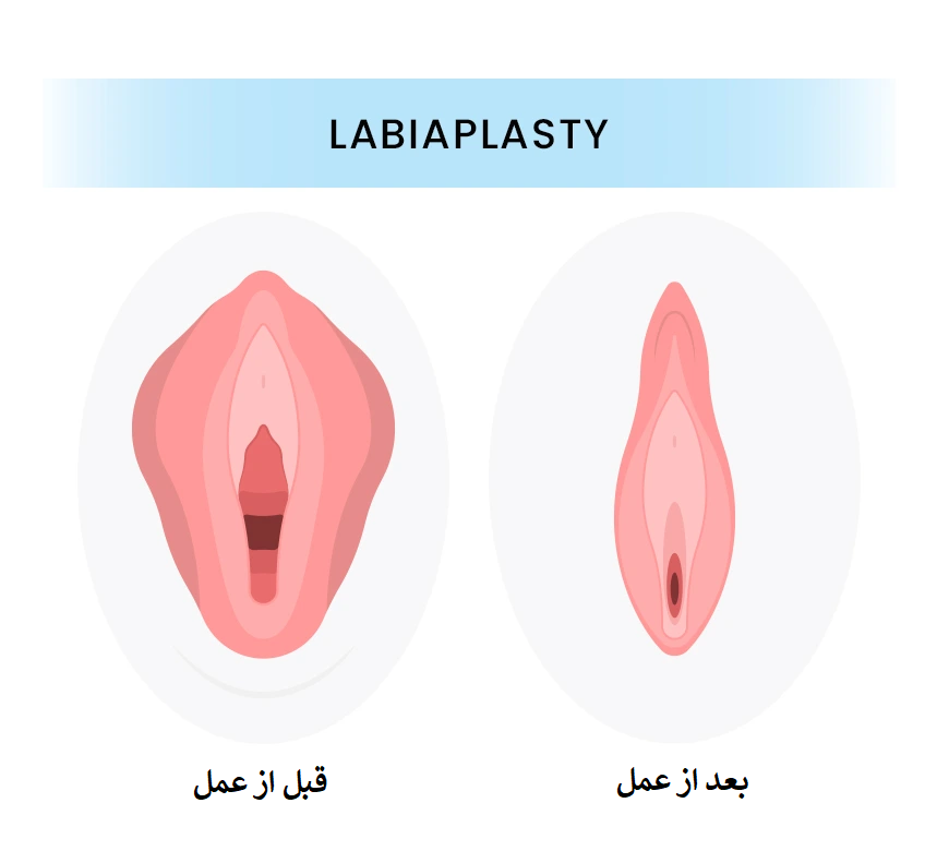 عمل لابیاپلاستی