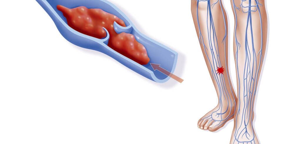 ترومبوز ورید عمقی DVT