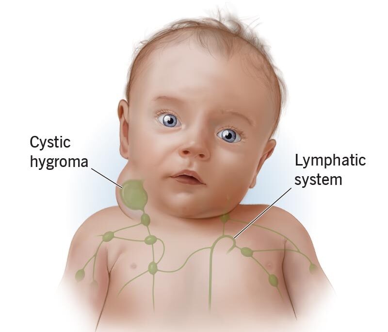 cystic hygroma