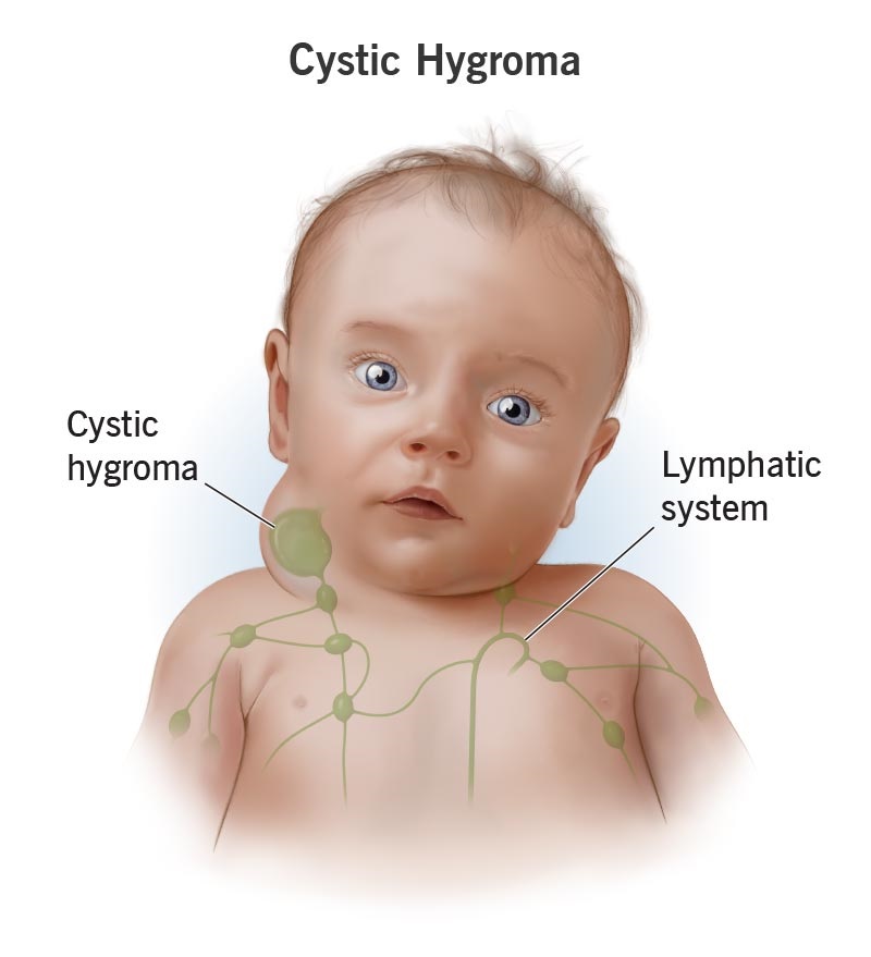 cystic hygroma