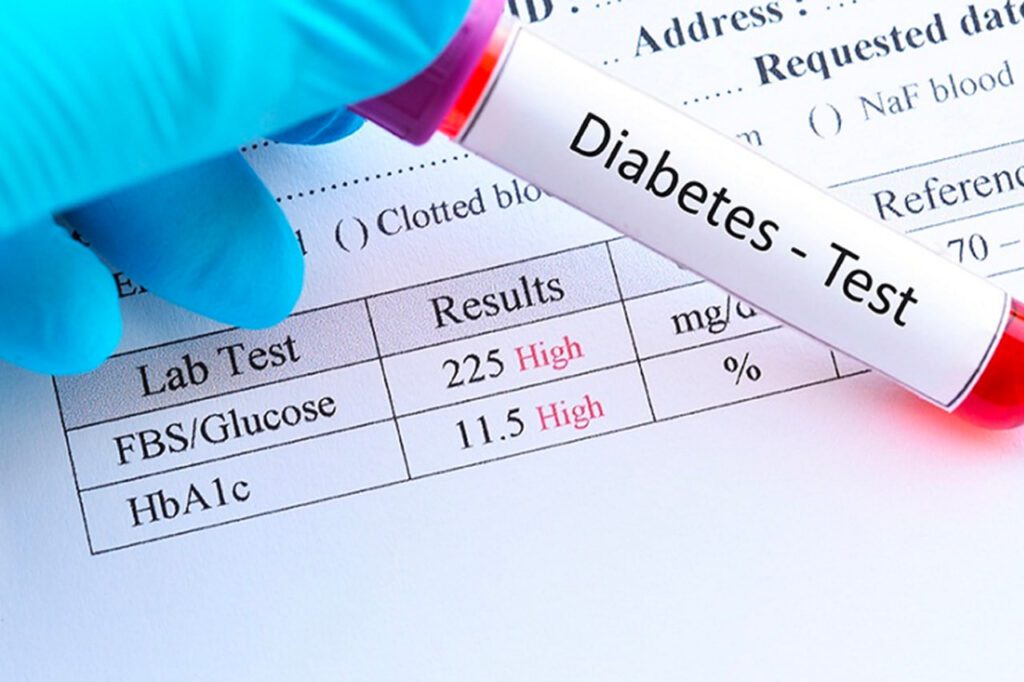 تست دیابت قبل از عمل چشم و لیزیک