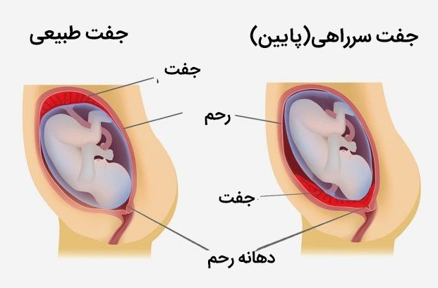 جفت سر راهی