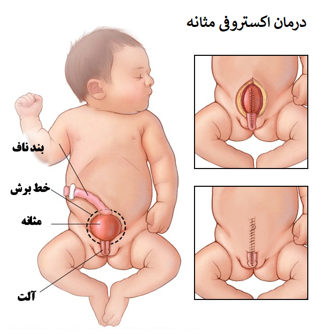 درمان اکستروفی مثانه