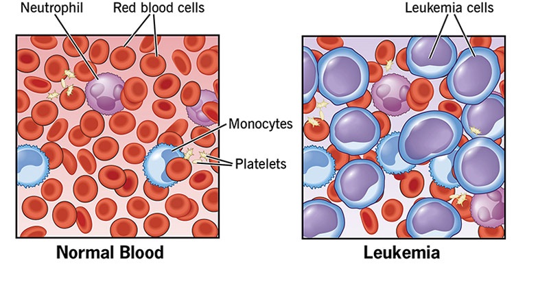 سرطان خون چیست؟