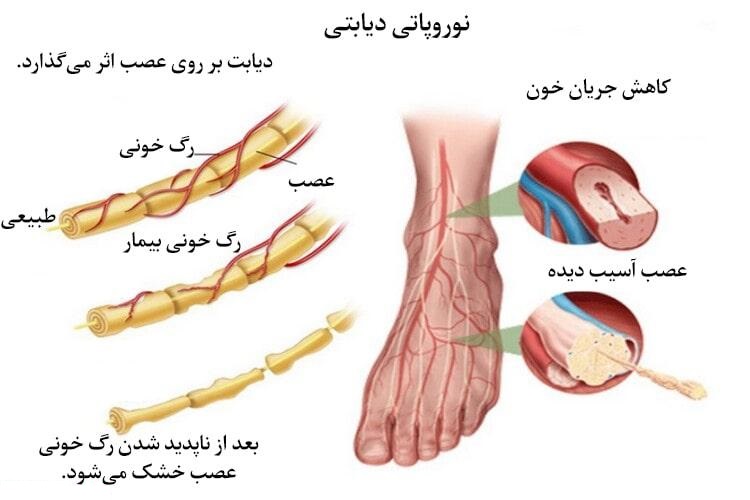 نوروپاتی دیابتی