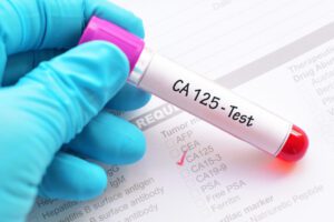 آزمایش آنتی ژن سرطانی CA-125