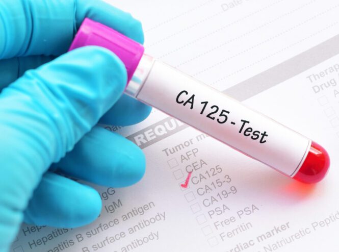 آزمایش آنتی ژن سرطانی CA-125