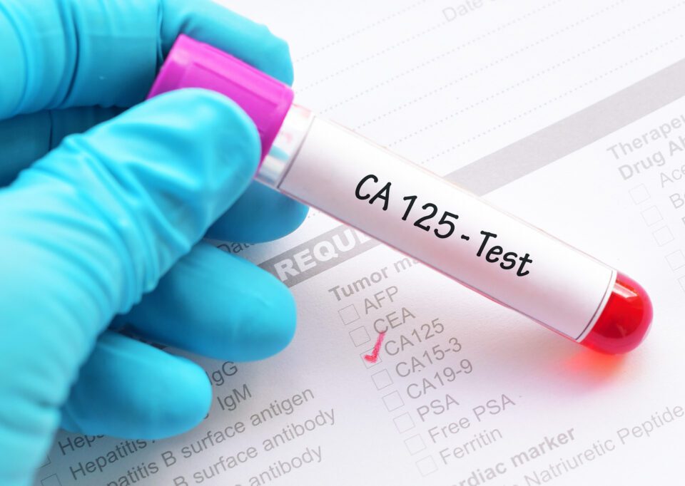 آزمایش آنتی ژن سرطانی CA-125