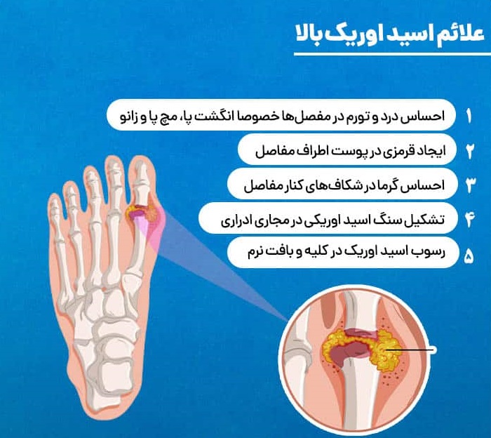علائم بالا بودن اسید اوریک خون